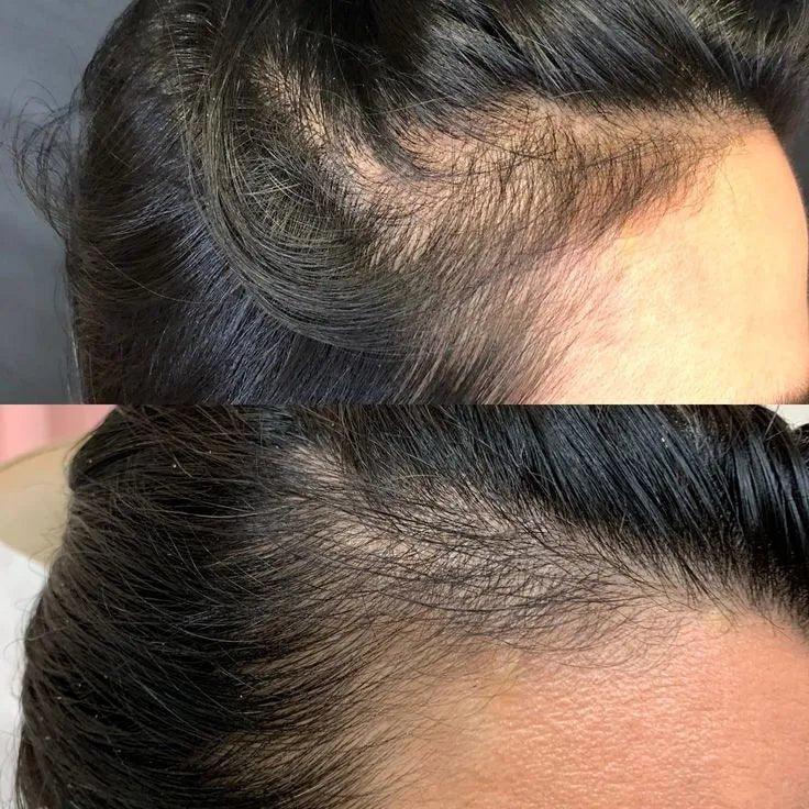 Comparaison avant-après pousse rapide des cheveux avec Power Hair Keratin 500 mg sur cuir chevelu