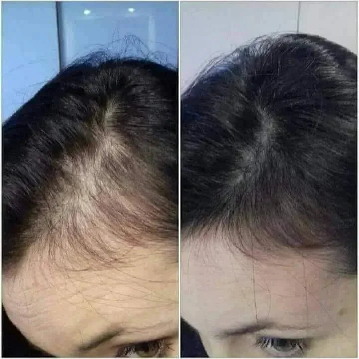 Chute de cheveux saisonnière : causes + routine simple en 30 jours | ADISAEL